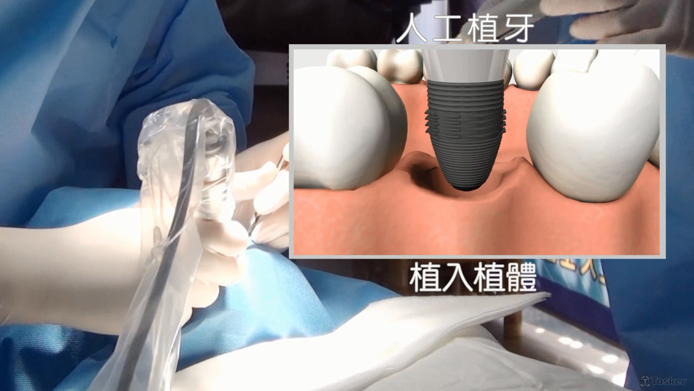人工植牙