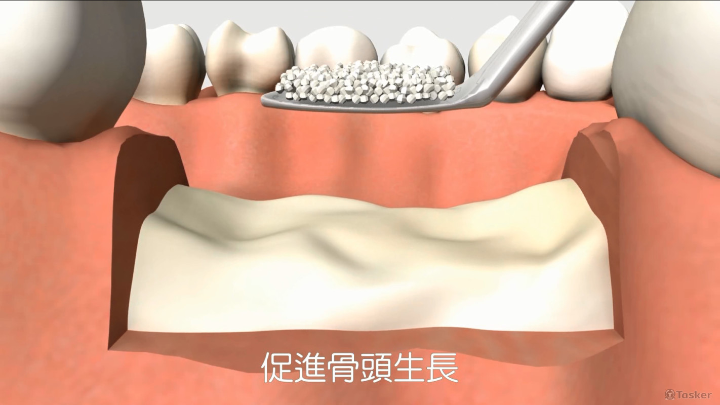 骨條件不足，補充膠原蛋白/骨粉