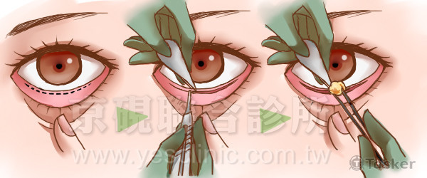 醫美診所 網頁用-手術示意圖(眼袋內開)
