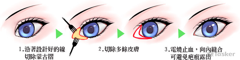 醫美診所 網頁用-手術示意圖(開眼頭)