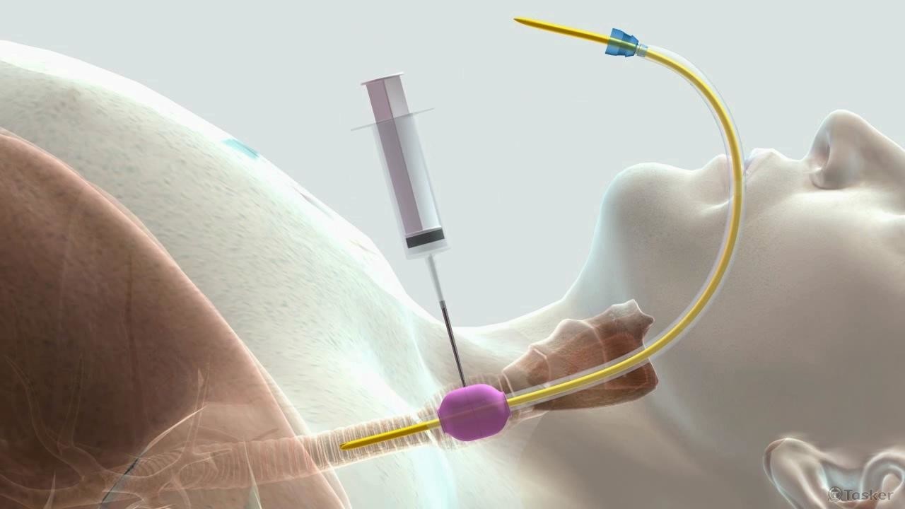 氣切手術 醫療模擬3D動畫-2
