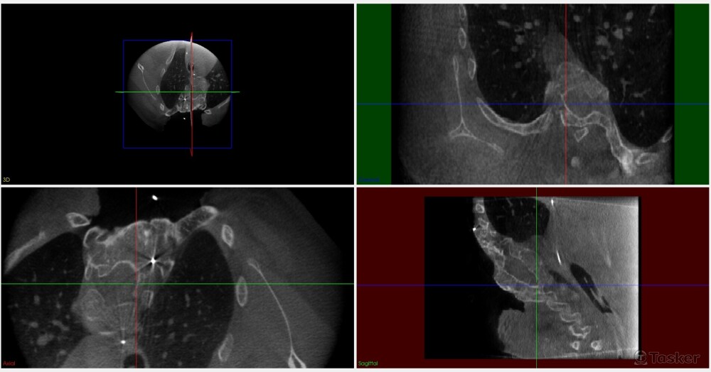 脊椎側彎案例dicom，原始正切視圖