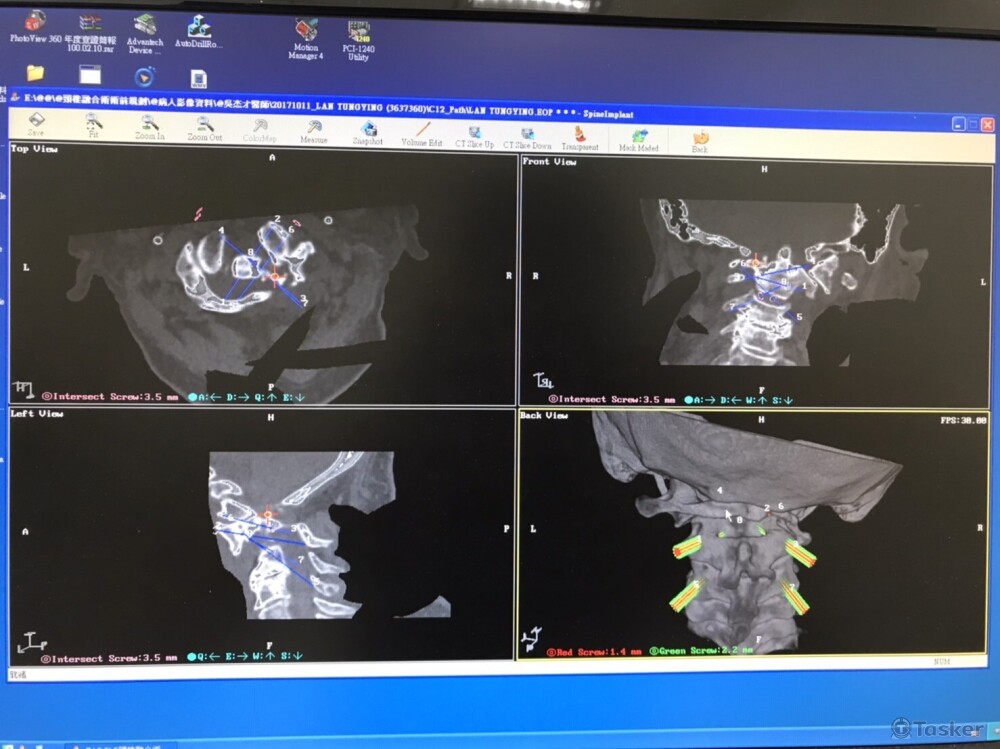 骨釘植入規畫系統-影像規畫介面